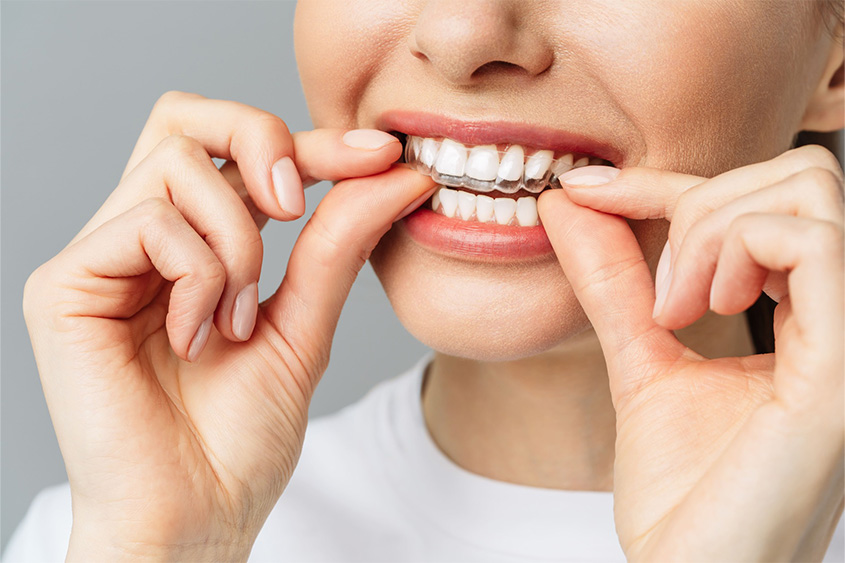 Invisalign beugel plaatsen Voorburg